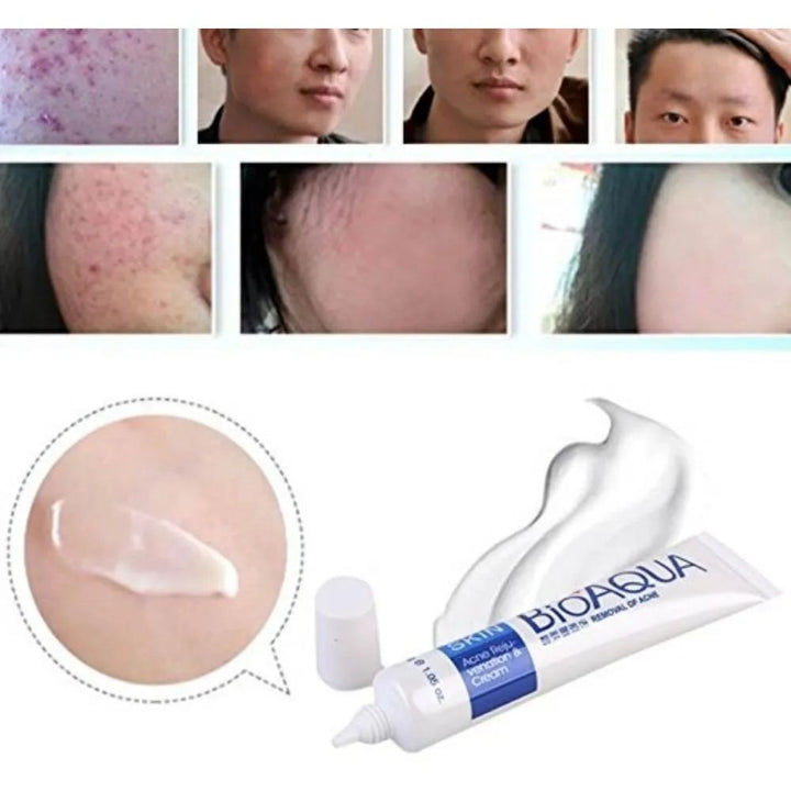 Crema Facial Removedora Acne 30g